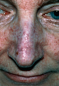 Patient's nose affected by Lupus Erythematosus