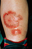 Lyell's disease on a child's leg
