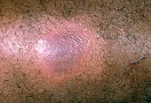 Lichen simplex rash on black skin