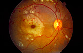 Ophthalmoscopy of systemic lupus erythematosus