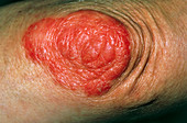 Close up of lichen planus skin rash on elbow
