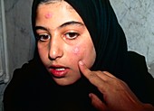 Cutaneous leishmaniasis lesion on teenager's face
