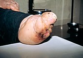 Deformed foot of a person suffering from leprosy
