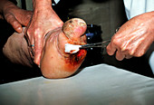 Cleaning a leprous foot with antiseptic