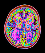 Coloured MRI brain scan showing lissencephaly