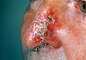 Skin rash on nose