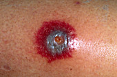 Lupus lesion