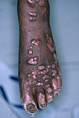 Leishmaniasis lesions