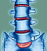 Spine disorder