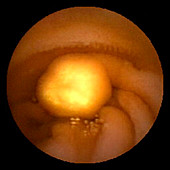 Lymphangiectasia in the jejunum
