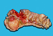 Lipoma of the sigmoid colon