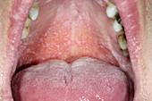 Oral lichen planus disease