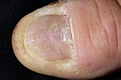 Thumbnail with lichen planus disease
