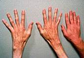 Hands of a person suffering from Marfan's syndrome