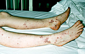 Patient legs with bacterial septiceamia