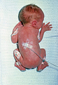 Newborn infant with congenital rubella