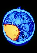 Coloured 3-D CT scan of brain with meningioma
