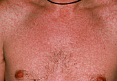 A severe measles rash on the chest of a man