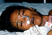 Vietnamese man with malarial jaundice (severe)
