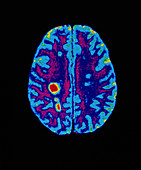 MRI scan of brain with multiple sclerosis