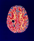 Col. MRI scan of a brain with multiple sclerosis