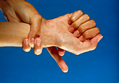 Marfan's syndrome: joint laxity and long fingers