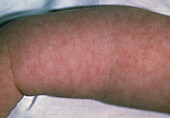 Baby girl's arm showing rash from viral meningitis
