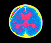 Coloured MRI brain scan of abscess in meningitis
