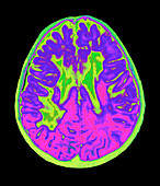 Coloured MRI brain scan showing multiple sclerosis