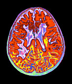 Multiple sclerosis brain,MRI scan
