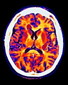 Multiple sclerosis,CT brain scan