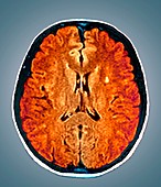 Multiple sclerosis,MRI brain scan