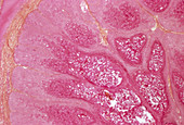 Molluscum contagiosum,light micrograph