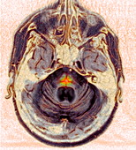Multi-system atrophy,MRI scan