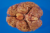 Meningioma brain tumour