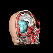 Brain tumour,3D scan