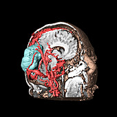 Brain tumour,3D scan