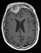 Mucocele growth,MRI scan