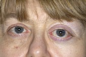 Meningioma causing bulging eye