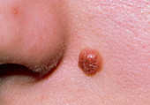 Ordinary mole on left of someone's nose
