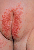 Nappy rash due to Candida infection