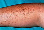 Pigmented naevi (moles) on the arm of a patient