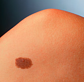 Pigmented naevus (benign mole) on a woman's knee