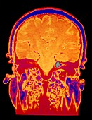 False-colour coronal MRI scan: acoustic neuroma