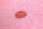 Close-up of benign melanocytic naevus (mole)
