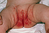 Candida nappy rash in a baby girl