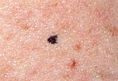 Close-up of a benign mole on skin of young man