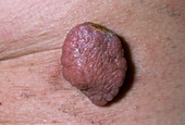 Skin tumour