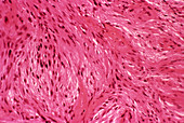 Neurinoma tumour,light micrograph