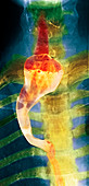 Neurofibromatosis affecting swallowing